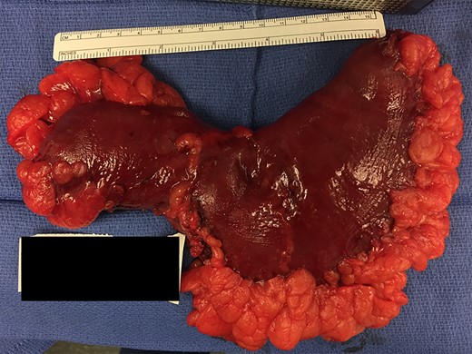 20 × 7 cm2 segment of abnormally dilated ileum.