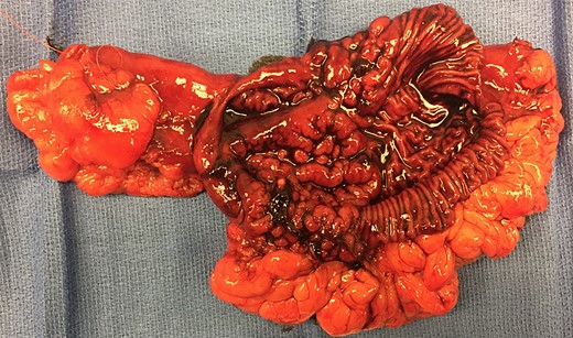 Resected specimen containing a 7 × 4.5 cm2 discrete island of abnormal appearing mucosa with rugal folding, later found to have histological characteristics consistent with heterotopic gastric tissue.