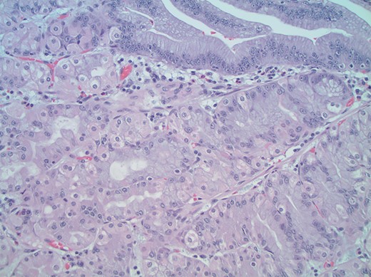 High-power magnification (×400) views of the mass show a mixture of gastric foveolar (top right) and fundic glandular epithelium including parietal and chief cells consistent with true gastric heterotopia.