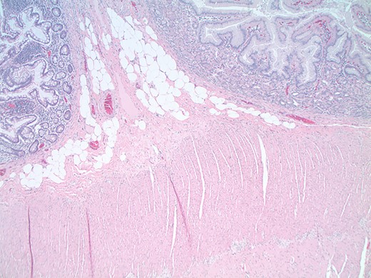Low-power magnification (×40) views of the interface between the gastric heterotopia (right) and the small intestinal epithelium (left). Note that the muscularis propria (bottom) contains an intact neuronal plexus between the muscular layers.