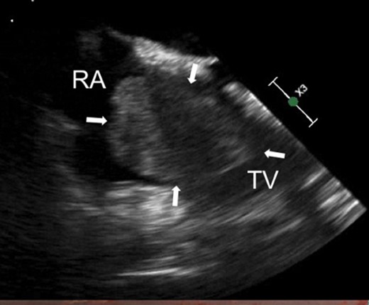 Arrows indicate large right atrial myxoma via transthoracic echocardiography. RA, right atrium; TV, tricuspid valve.