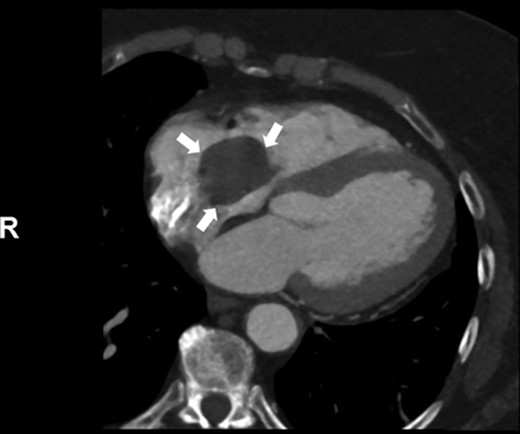Arrows indicate large right atrial myxoma on CT scan.