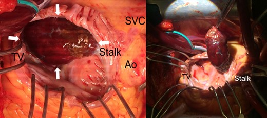 Right atrial mass in situ, looking at the patient from the left. Close up on the left and prior to excision on the right. TV, tricuspid valve; SVC, superior vena cava; Ao, aorta.