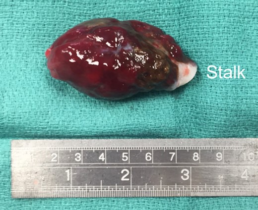 Right atrial mass measuring 7 cm in length.