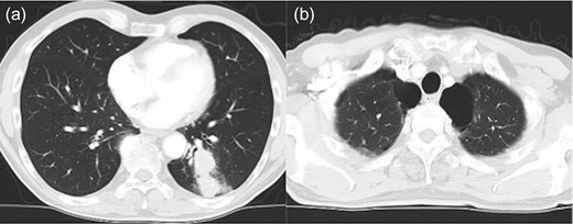 Chest computed tomography shows lung cancer in the left lower lobe of the lung (a) and an emphysematous lung with bullae in the lung apex, bilaterally (b).