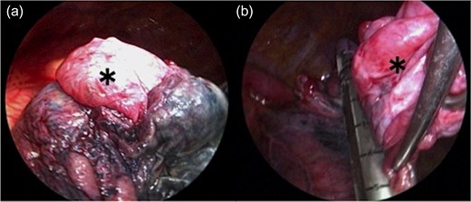 The bulla (*) wall in the apex of the lung was very thin (a). Following left lower lobectomy, the resection of emphysematous bullae (*) was performed (b).