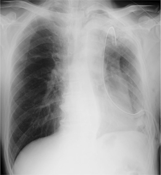 Chest X-ray image 2 h after the presence of bloody drainage from the thoracic tube caused suspicion of a left hemothorax.
