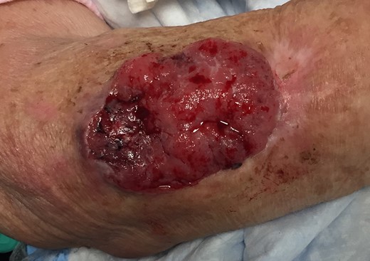 Forearm before surgical excision showing a protuberant mass with irregular tissue and active bleeding.