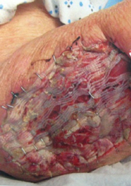 Forearm after surgical excision and placement of skin graft from the right thigh.