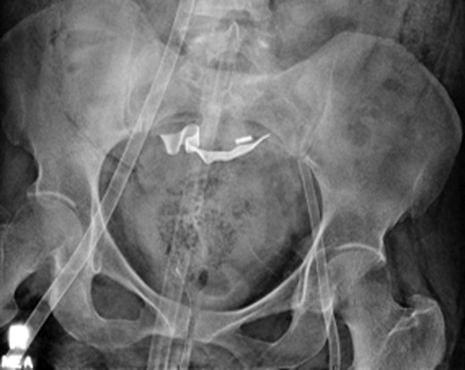 Abdominal x-ray of VA-ECMO cannulation within the IVC and left iliac artery.
