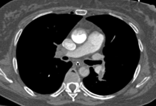 CTA chest showing significant pulmonary embolic clot burden occluding the right and left upper lung lobes.