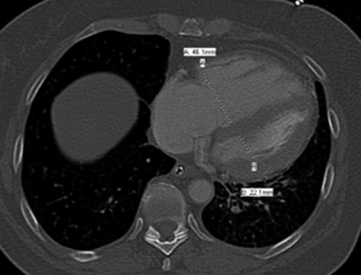 CTA chest demonstrating significant RV strain with a RV/LV ratio of 2.1.