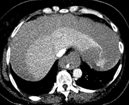 CTA abdomen performed when the patient had abdominal compartmental syndrome requiring massive transfusion protocol. CTA showing extensive hemoperitoneum with active extravasation from the left lobe of the liver.