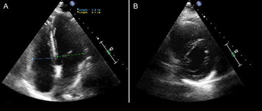 Echocardiogram performed 2 days after removal of VA-ECMO cannulation showing a normalized RV/LV ratio without evidence of RV dysfunction. (A) Four-chamber apical view. (B) Parasternal short access view.