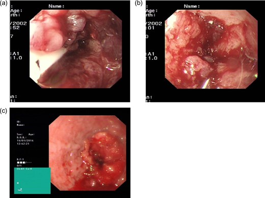 Gastroscopy findings. BH: (a) an area of thickening proximal to the gastro-oesophageal junction can be seen, BH: (b) with considerable oedema and dilatation of the oesophagus. PM: (c) a malignant stricture identified at 35 cm, with overlying friable mucosa.