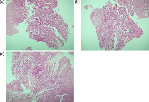 Histology findings. PM: (a–c) distal oesophagus biopsies, including at the level of the oesophageal stricture described in Fig. 1. Diffuse infiltration of stromal tissue by poorly differentiated adenocarcinoma is seen; parts of tumour exhibit tubule formation, and are lined by columnar cells which themselves demonstrate pleomorphic nuclei and epithelial tufting.