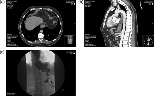 Imaging. PM: (a) axial CT section showing hypodensity in segment VIII of the liver, likely representing metastasis. BH: (b) Sagittal CT section demonstrating features of malginancy in the distal third of the oesophagus; dilatation of the middle and upper parts is notable owing to distal stenosis, and a soft tissue-density lesion is apparent in the final 5 cm. BH: (c) barium swallow study showing stasis in the distended lower oesophagus, with almost no contrast observed entering the stomach.