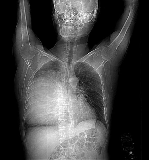 Chest radiography showing a large opacity in the right hemithorax.