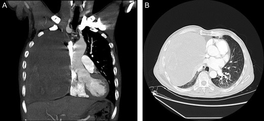 (A and B) Contrast-enhanced CT showing a very large heterogeneous mass in the right hemithorax.