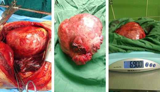 (A–C) Large encapsulated mass.