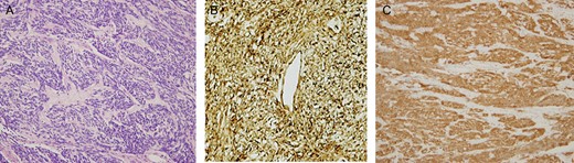 (A–C) Light microscopy of the resected tumor (H&E stain) revealed patternless spindle tumor cells mixed with varying amounts of collagen, and hyalinization of fibrous tissue (A). Positive immunoreactivity of tumor cells. CD34 (B) and BCl2 (C).