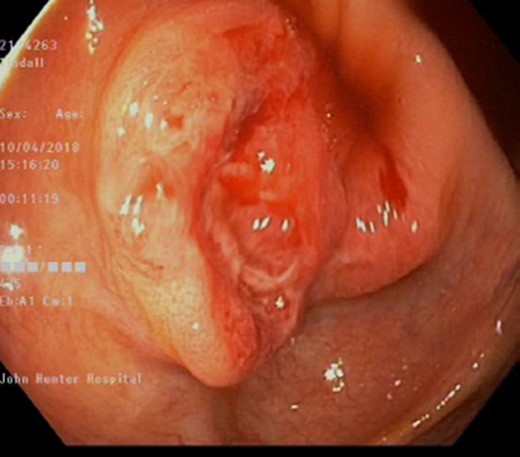 Endoscopic view of ulcerated caecal lesion.