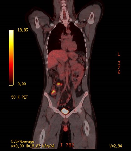 PET scan, demonstrating increased uptake in the caecum and likely mesentery lymph nodes.