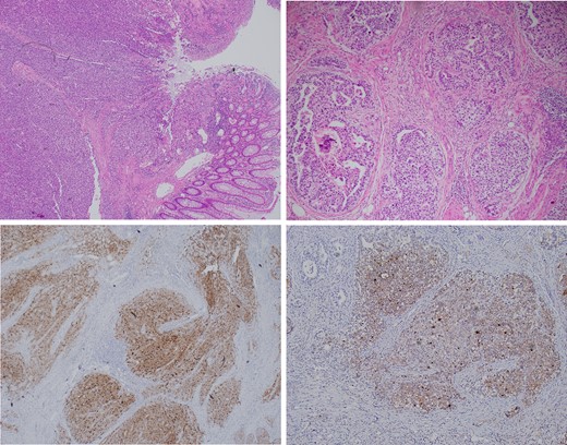 Top left: A low power view of colonic mucosa giving way to the solid tumour mass which involves the mucosa, submucosa and muscularis propria. Top right: A high-power view of the primitive appearance of a YST showing glomeruloid, microcystic and solid architecture and high-grade cytology. Focal necrosis is also observed. Bottom left: The tumour shows diffuse immunohistochemical staining for Glypican 3. Bottom right: The tumour shows diffuse immunohistochemical staining for AFP.