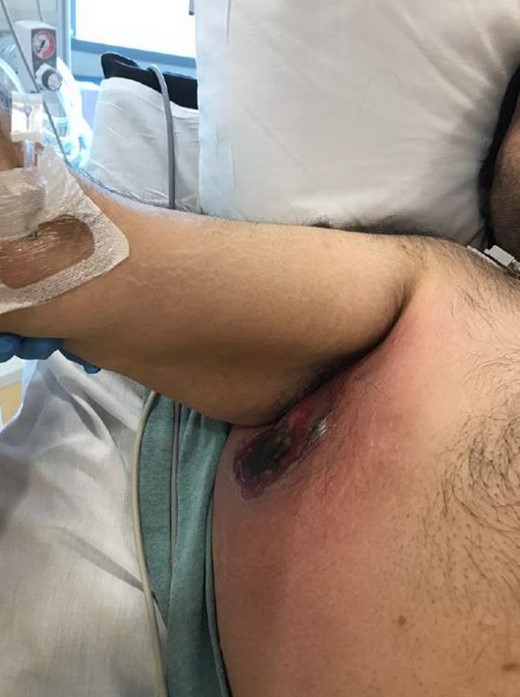 Pre-operative right axilla/chest wall.