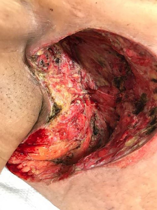 Post-excision right axilla/chest wall.