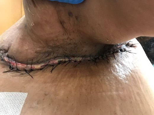 Wound closure.