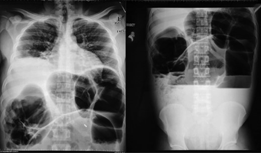 Erect chest and abdominal X-rays showing dilated colon and air–fluid levels.