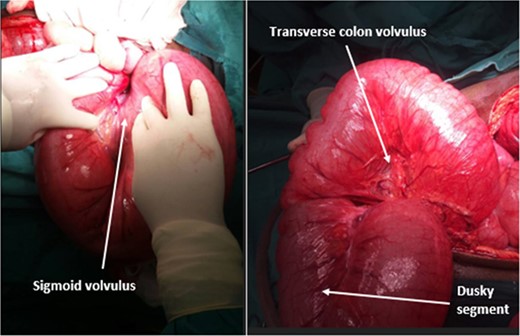 Sigmoid volvulus and transverse colon volvulus.