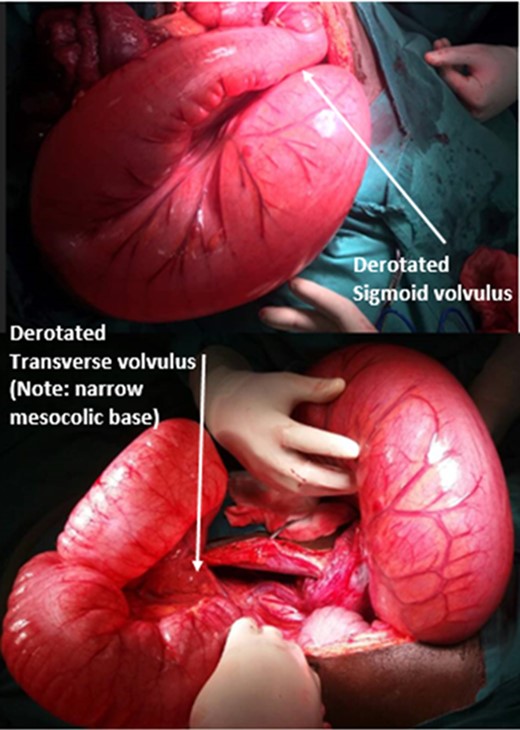 Post-derotation of the sigmoid and transverse volvulus.
