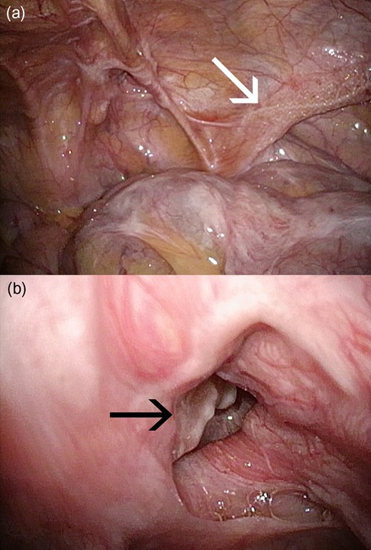 (a) The re-recurrent hernia orifice was confirmed between the mesh (white arrow) at the primary repair and the mesh plug at the secondary repair by transabdominal preperitoneal repair. (b) The mesh plug (black arrow) at the secondary repair got detached from the outside and migrated into the preperitoneal cavity.