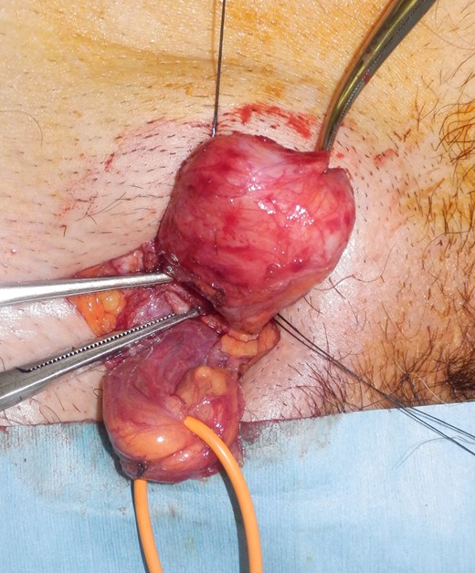 The hernia sac was easily confirmed because it protruded with abdominal air pressure.