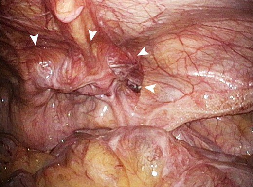 By observing from the abdominal cavity, the position of the inlay mesh (arrow head) in the preperitoneal cavity was confirmed to be appropriate.