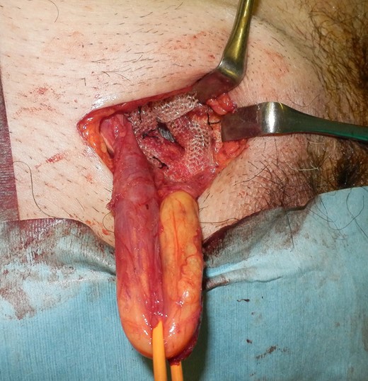 The onlay mesh was fixed on the transverse fascia.