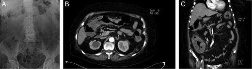(A) Abdominal x-ray, without signs of pneumoperitoneum. (B) Abdominal CT, with diffuse colonic mural thickening and enhancement. (C) Abdominal CT with pericolonic stranding.
