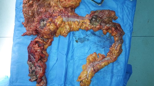 Total colectomy, with multiple areas of necrosis.