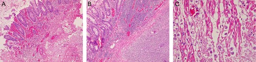 (A) Colonic ulcer, with inflammatory reaction, and hemorrhage. (B) Severe inflammatory reaction on the bowel wall. (C) Trophozoites of Entamoeba histolytica invading the colonic wall.