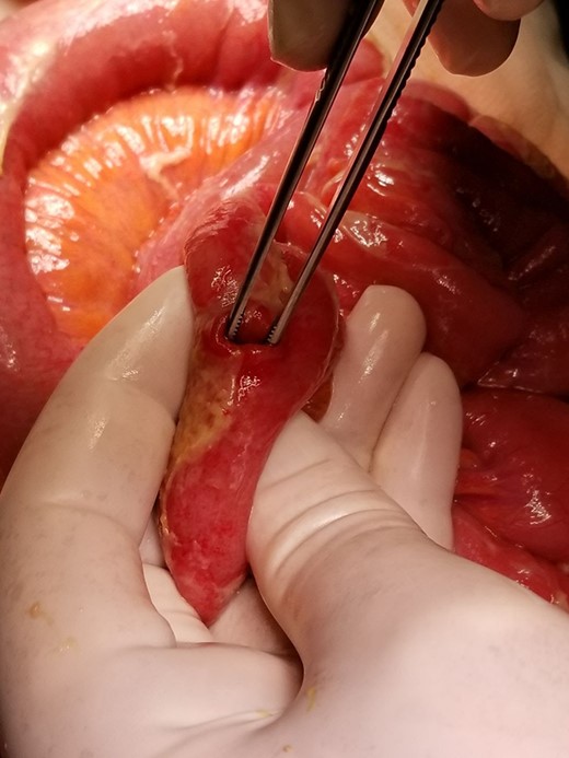 Isolated small bowel perforation, situated 100 cm proximally from the ileo-caecal valve due to seat belt.