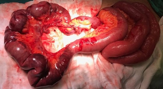 Small bowel’s mesenteric laceration starting from 10 cm above the ileo-ceacal valve. This bowel segment was ischemic but had no perforation.