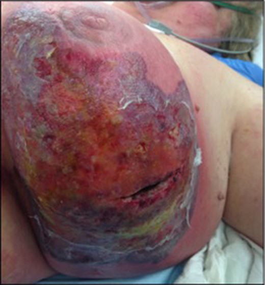 Extensive cellulitis with superficial ulceration post second drainage and
debridement.