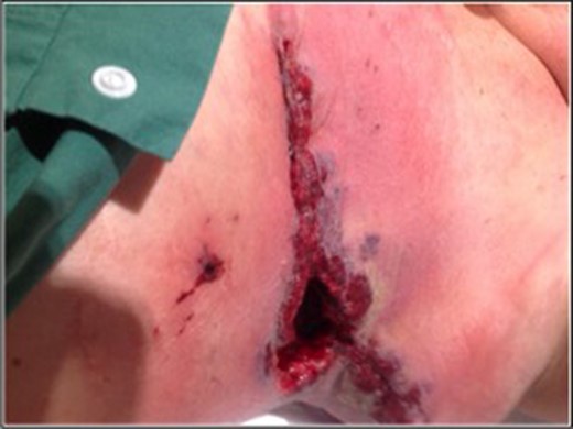 Image taken prior to mastectomy stitches being cut, wound shows granulation tissue and
classic violaceous border of pyoderma gangrenosum.