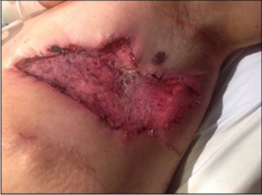 Post application of split skin graft.