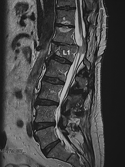 MRI: spinal cord injury secondary to L1 vertebral fracture.