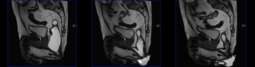 Dynamic MRI: incomplete contrast evacuation.