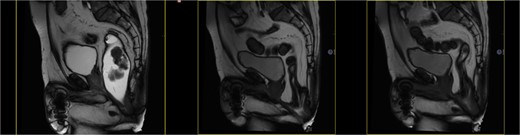 Dynamic MRI: complete contrast evacuation.