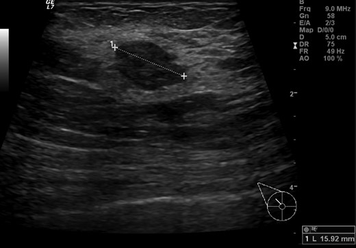Breast ultrasonography showing an irregular 15 mm hypoechoic lump with no acoustic shadowing between right upper quadrants.